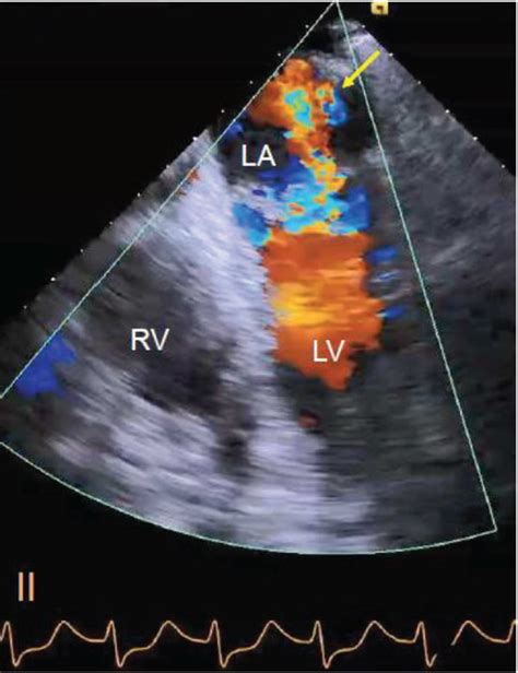 anteroseptal wall echo.